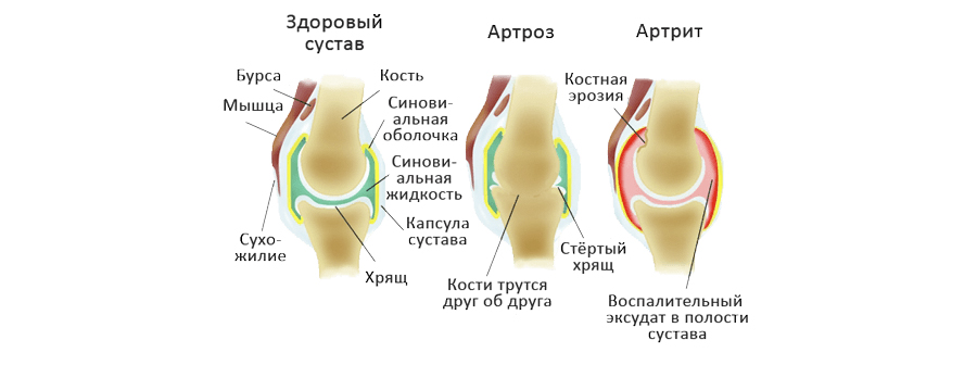 Артриты и артрозы гомеопатические препараты