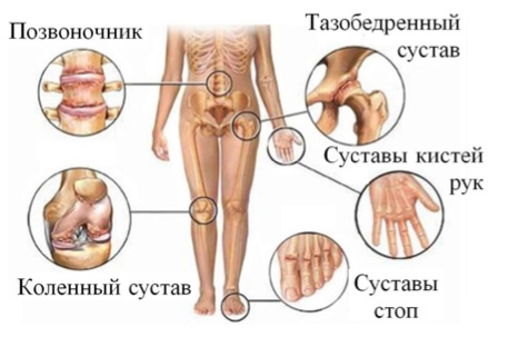 Артриты и артрозы гомеопатические препараты